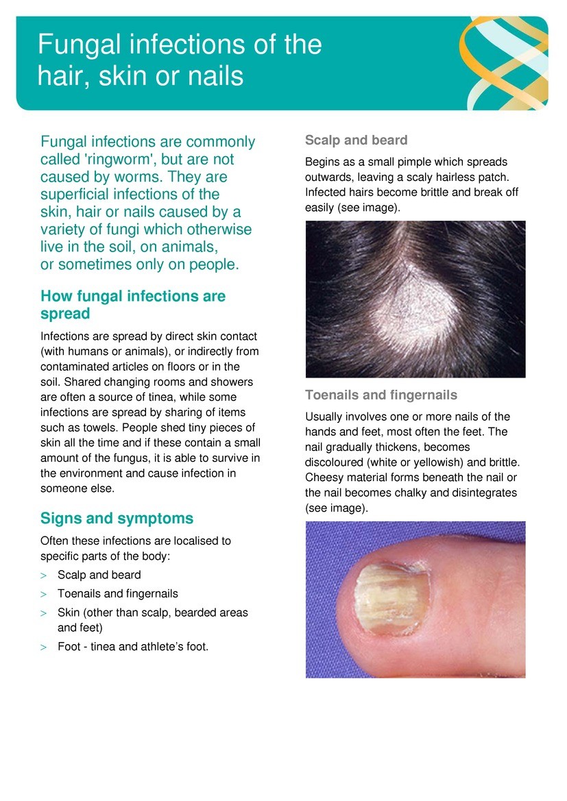Ring Worm - Fungal infections
